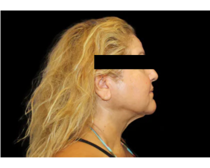 Neck Liposuction Before & After Patient #2826