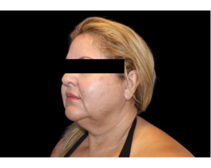 Neck Liposuction Before & After Patient #2826
