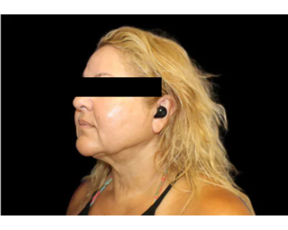 Neck Liposuction Before & After Patient #2826