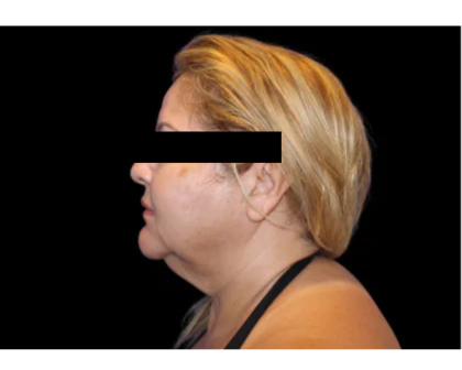 Neck Liposuction Before & After Patient #2826