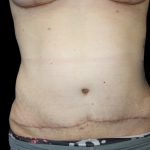 Tummy Tuck Before & After Patient #2858
