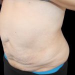 Tummy Tuck Before & After Patient #2858