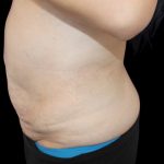 Tummy Tuck Before & After Patient #2858