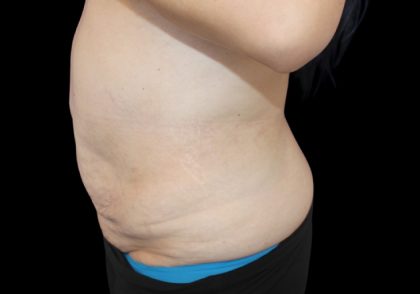 Tummy Tuck Before & After Patient #2858