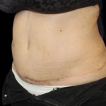 Tummy Tuck Before & After Patient #2869