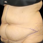 Tummy Tuck Before & After Patient #2869