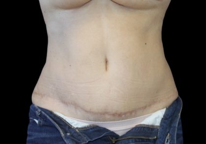 Tummy Tuck Before & After Patient #2869