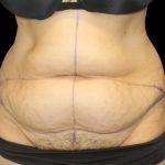 Tummy Tuck Before & After Patient #2869
