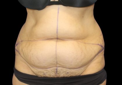 Tummy Tuck Before & After Patient #2869