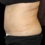 Tummy Tuck Before & After Patient #2869
