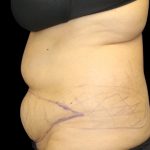 Tummy Tuck Before & After Patient #2869