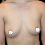 Breast Augmentation (Silicone) Before & After Patient #2453