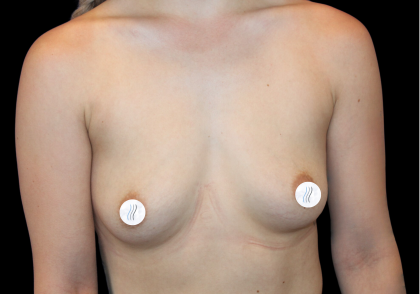Breast Augmentation (Silicone) Before & After Patient #2453
