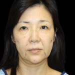 Blepharoplasty Before & After Patient #2451
