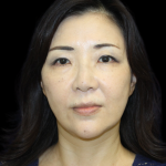 Blepharoplasty Before & After Patient #2451