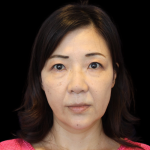 Blepharoplasty Before & After Patient #2451