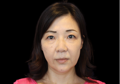 Blepharoplasty Before & After Patient #2451