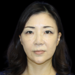 Blepharoplasty Before & After Patient #2451