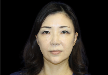 Blepharoplasty Before & After Patient #2451