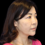 Blepharoplasty Before & After Patient #2451