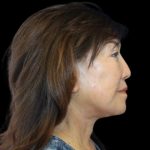 Neck Lift Before & After Patient #2903