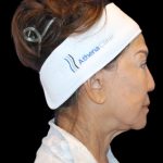 Neck Lift Before & After Patient #2903