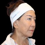 Neck Lift Before & After Patient #2903