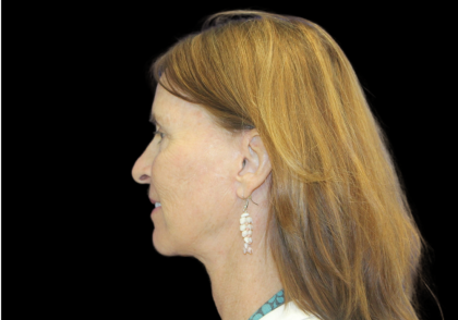 Blepharoplasty Before & After Patient #2452