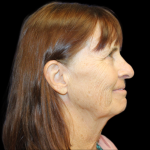 Blepharoplasty Before & After Patient #2452