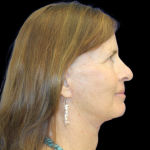 Blepharoplasty Before & After Patient #2452