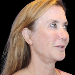 Neck Lift Before & After Patient #2474