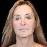 Neck Lift Before & After Patient #2474