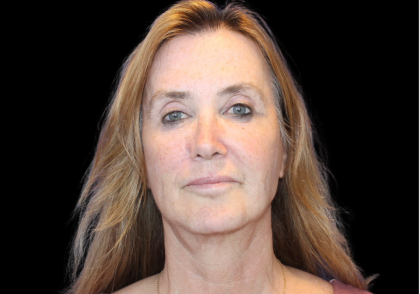 Facelift Before & After Patient #2469