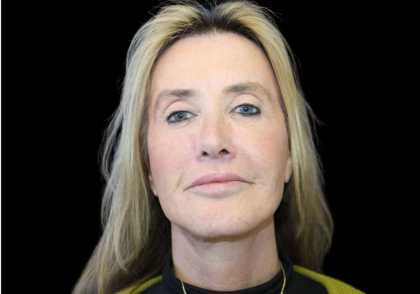 Facelift Before & After Patient #2469