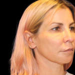 Neck Lift Before & After Patient #2475