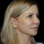 Neck Lift Before & After Patient #2475