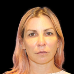Neck Lift Before & After Patient #2475