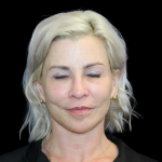 Neck Lift Before & After Patient #2475