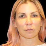 Neck Lift Before & After Patient #2475