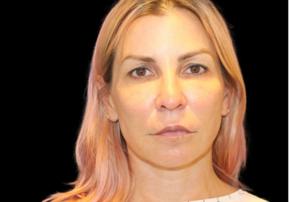 Facelift Before & After Patient #2470