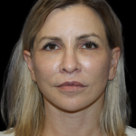 Neck Lift Before & After Patient #2475