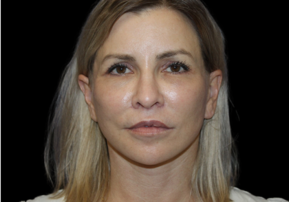 Facelift Before & After Patient #2470
