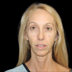 Neck Lift Before & After Patient #2476