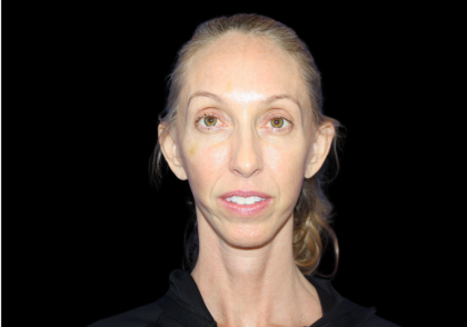 Facelift Before & After Patient #2471