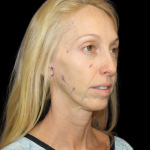 Neck Lift Before & After Patient #2476