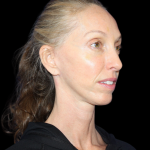 Neck Lift Before & After Patient #2476