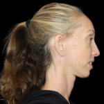 Neck Lift Before & After Patient #2476