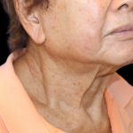 Fat Grafting Neck & Chin Before & After Patient #2900