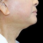Fat Grafting Neck & Chin Before & After Patient #2900