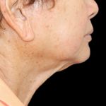 Fat Grafting Neck & Chin Before & After Patient #2900